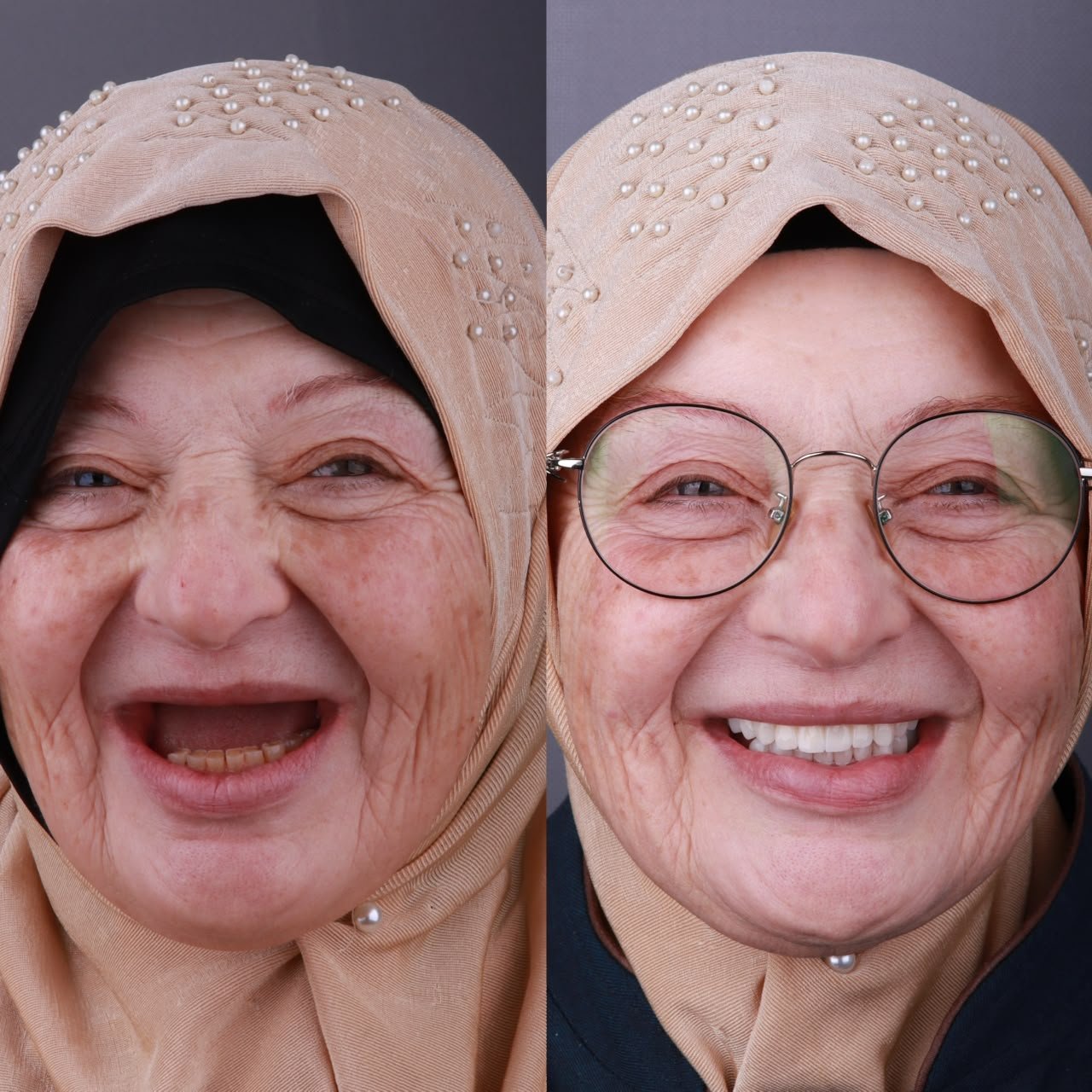 Dental Implants Before and After