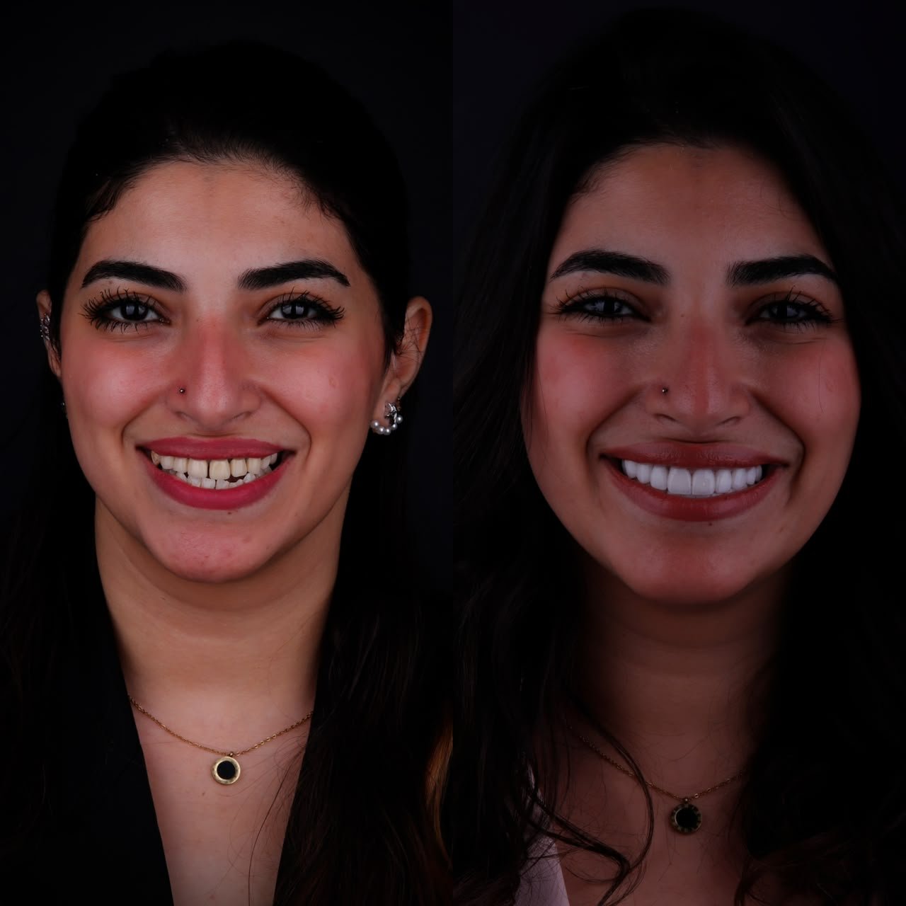 Smile Makeover Before and After