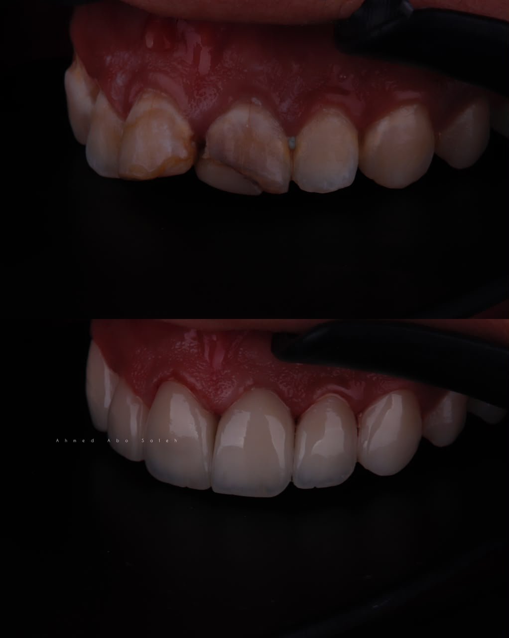 Ceramic Veneers Before and After